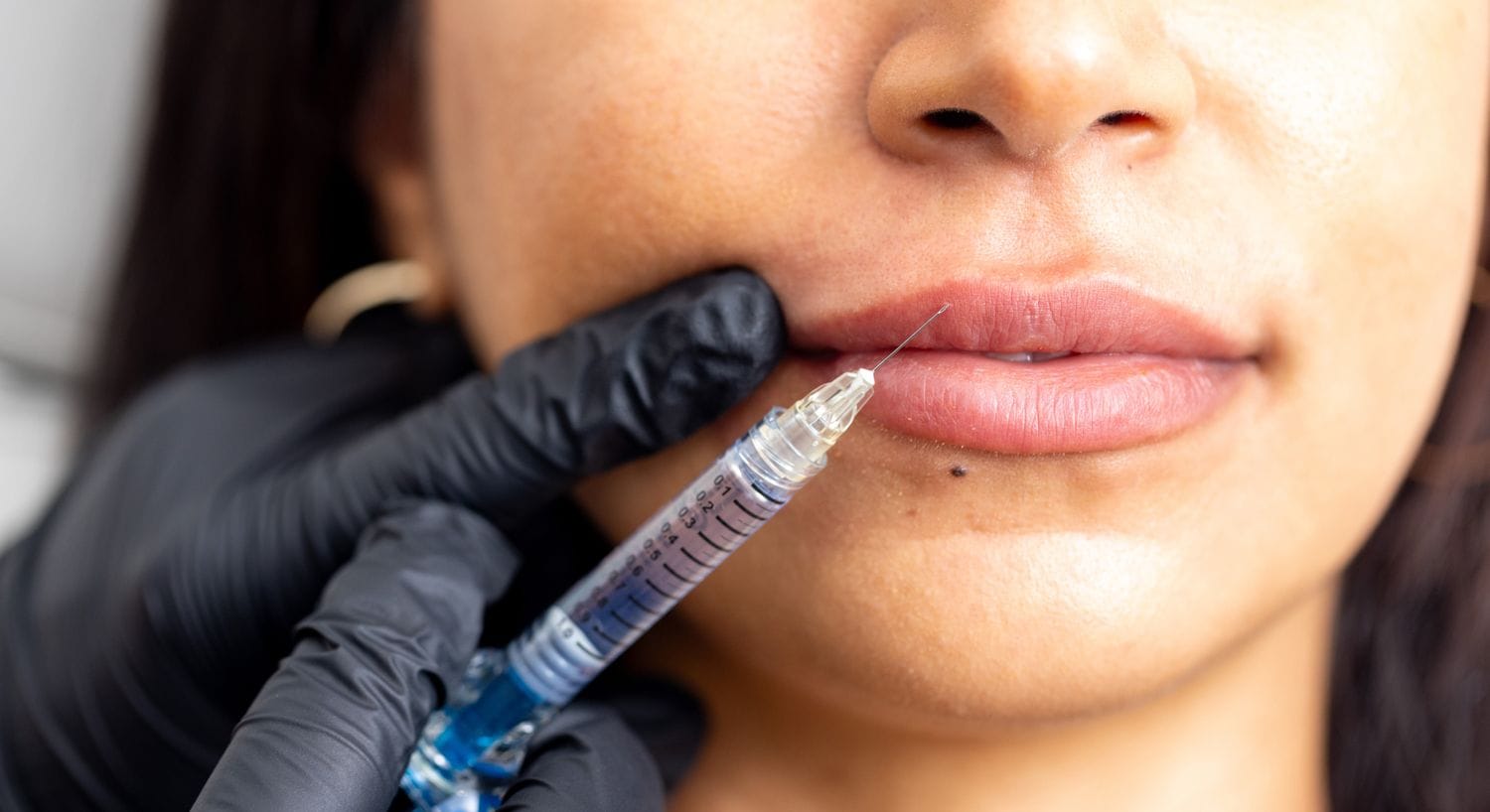 Transparente Beratung zu kosten fett weg spritze bei MorySkin